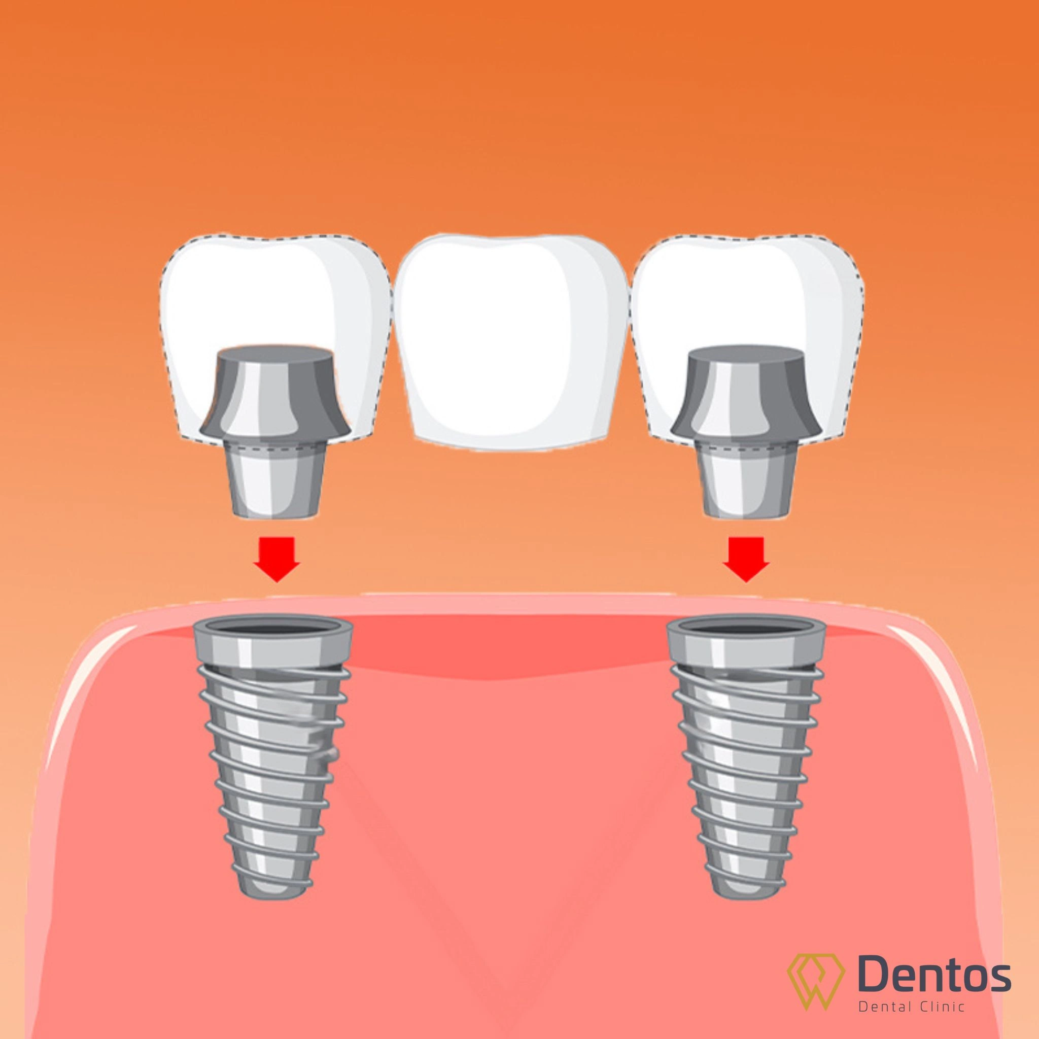 Trồng răng Implant là cấy chân răng Titanium vào xương hàm tại vị trí răng mất